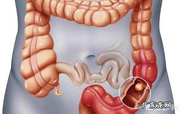 大便又细又稀是怎么回事?