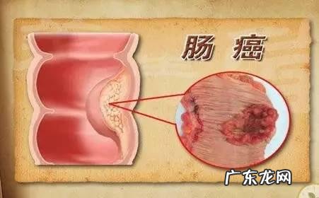 大便又细又稀是怎么回事?