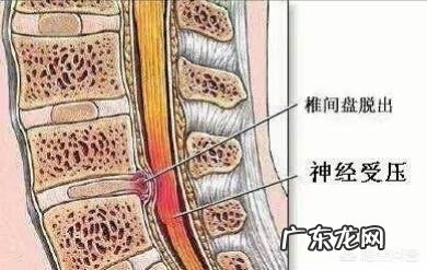 腰椎间盘突出,压迫坐骨神经痛,该怎么办?