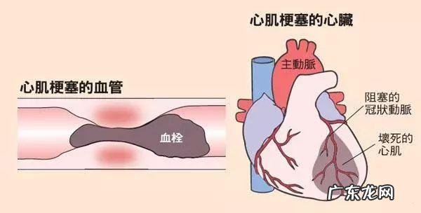 急性心肌梗死中医怎么zhi? 急性心肌梗塞用中医怎么康复