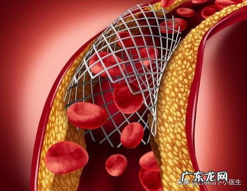 心脏装了支架后,吃双抗出血怎么办?