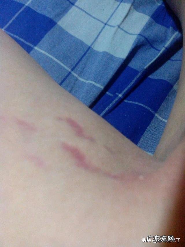 小男孩十四岁半,膝盖有生长纹还会不会长高? 14岁有生长纹还能长高吗