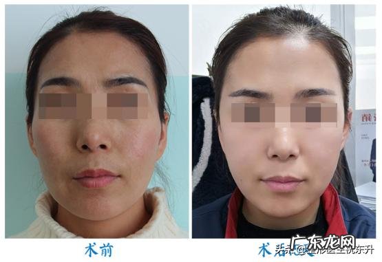 自体脂肪填充到底怎么样?