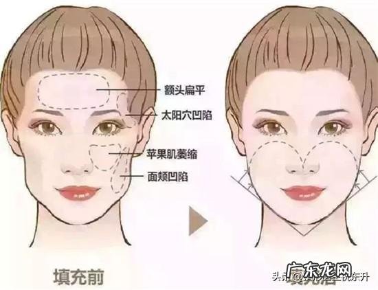 自体脂肪填充到底怎么样?