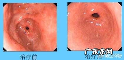 萎缩性胃炎在胃炎中,是不是最重的呢?