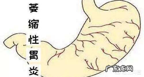 萎缩性胃炎在胃炎中,是不是最重的呢?