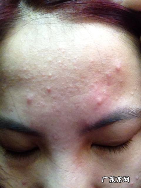 有没有什么生活小常识可以改善痘痘?