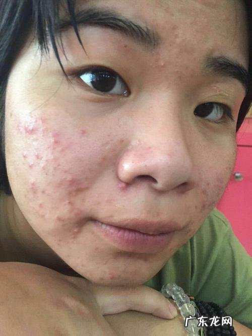 有没有什么生活小常识可以改善痘痘?