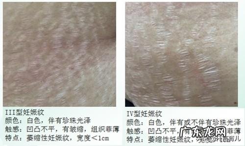 什么样的准妈妈容易早产?