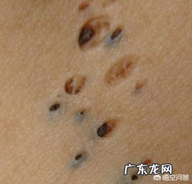 毛孔粗大的皮肤需要怎么护理才能收缩毛孔？