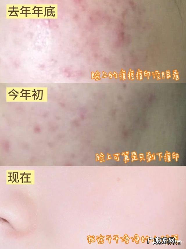 怎么样可以让肌肤不起痘痘,变好? 痘痘肌肤用什么水乳