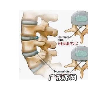健身中,有什么动作可以很好的缓解腰突的疼痛?