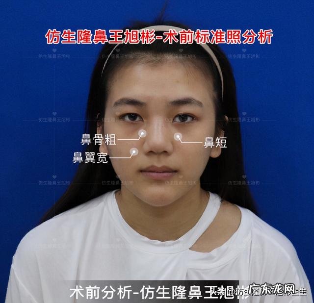 耳软骨隆鼻后5天鼻头大 耳软骨隆鼻一个月了鼻头很大