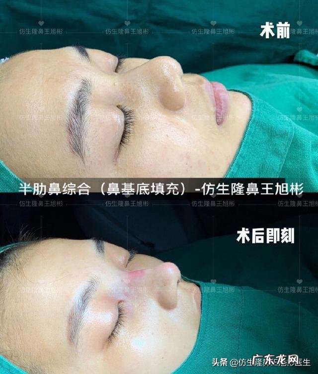 耳软骨隆鼻后5天鼻头大 耳软骨隆鼻一个月了鼻头很大