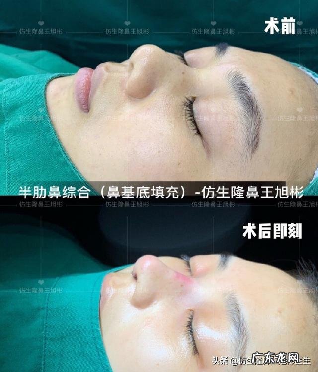 耳软骨隆鼻后5天鼻头大 耳软骨隆鼻一个月了鼻头很大
