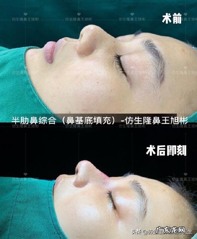 耳软骨隆鼻后5天鼻头大 耳软骨隆鼻一个月了鼻头很大