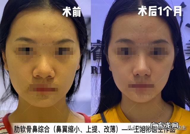 耳软骨隆鼻后5天鼻头大 耳软骨隆鼻一个月了鼻头很大