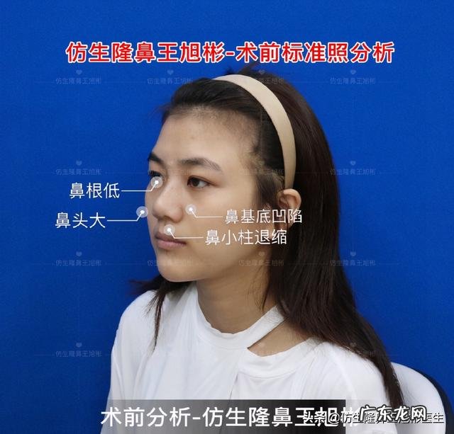 耳软骨隆鼻后5天鼻头大 耳软骨隆鼻一个月了鼻头很大