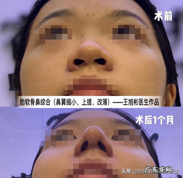 耳软骨隆鼻后5天鼻头大 耳软骨隆鼻一个月了鼻头很大