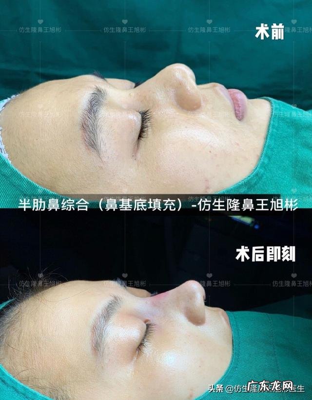 耳软骨隆鼻后5天鼻头大 耳软骨隆鼻一个月了鼻头很大
