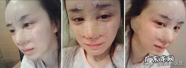 隆鼻的方法有几种及各自的优缺点 隆鼻的方法有哪些这4种很常见