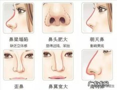 隆鼻的方法有几种及各自的优缺点 隆鼻的方法有哪些这4种很常见