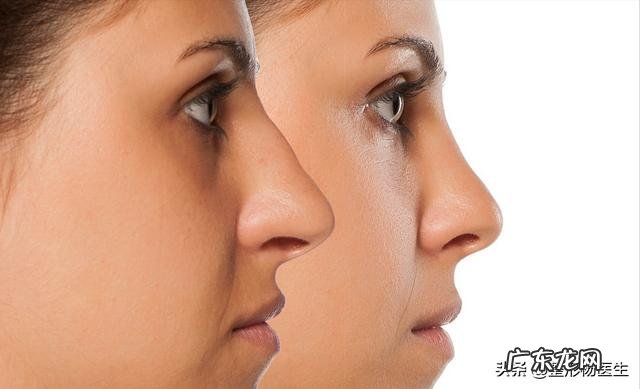 隆鼻的方法有几种及各自的优缺点 隆鼻的方法有哪些这4种很常见