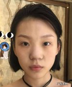 耳软骨隆鼻和肋软骨隆鼻怎么选 鼻软骨和肋软骨隆鼻哪种比较好