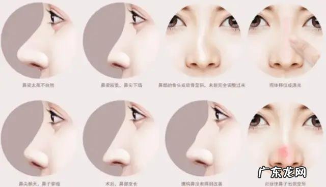 隆鼻鼻头太尖该怎么修复 隆鼻鼻头太长怎么修复