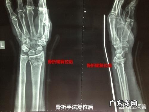 有人说老人骨折后,一般寿命不长,是真的吗?