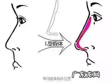 隆鼻手术的几种方式 如何选择隆鼻手术方法