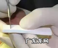 隆鼻手术的几种方式 如何选择隆鼻手术方法