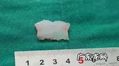 隆鼻手术的几种方式 如何选择隆鼻手术方法