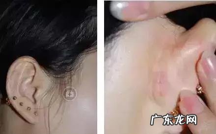 隆鼻手术的几种方式 如何选择隆鼻手术方法