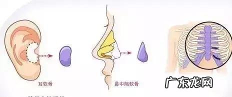 隆鼻手术的几种方式 如何选择隆鼻手术方法