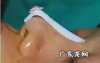 隆鼻手术的几种方式 如何选择隆鼻手术方法