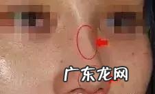 隆鼻手术的几种方式 如何选择隆鼻手术方法