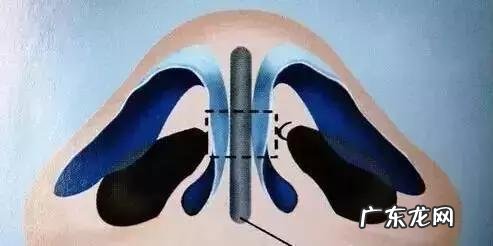 隆鼻手术的几种方式 如何选择隆鼻手术方法