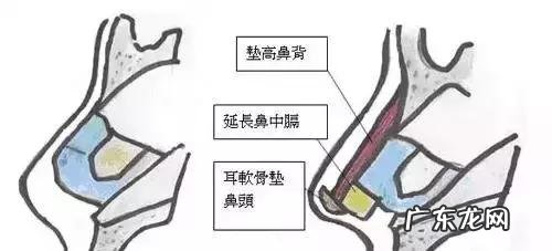 隆鼻手术的几种方式 如何选择隆鼻手术方法