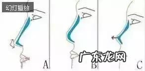 隆鼻手术的几种方式 如何选择隆鼻手术方法