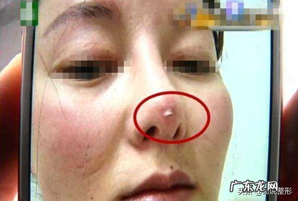 注射隆鼻失败怎么办 隆鼻失败的症状及治疗