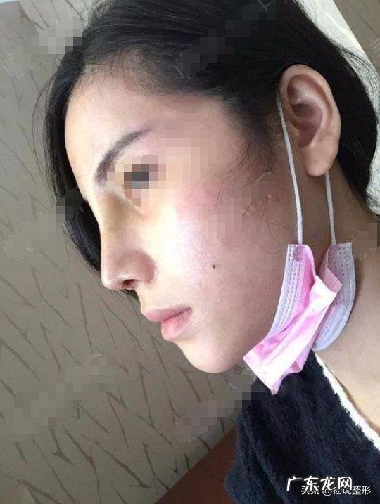 注射隆鼻失败怎么办 隆鼻失败的症状及治疗