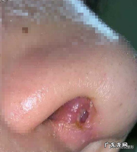 注射隆鼻失败怎么办 隆鼻失败的症状及治疗