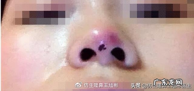 隆鼻过后最大的后遗症是什么 北京隆鼻整形后遗症