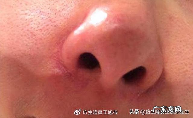 隆鼻过后最大的后遗症是什么 北京隆鼻整形后遗症