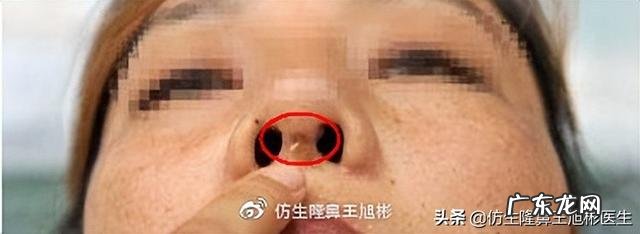 隆鼻过后最大的后遗症是什么 北京隆鼻整形后遗症