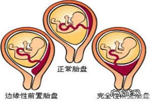 “胎盘低置状态”你有听说过吗是怎样的