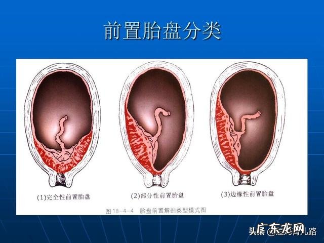 “胎盘低置状态”你有听说过吗是怎样的