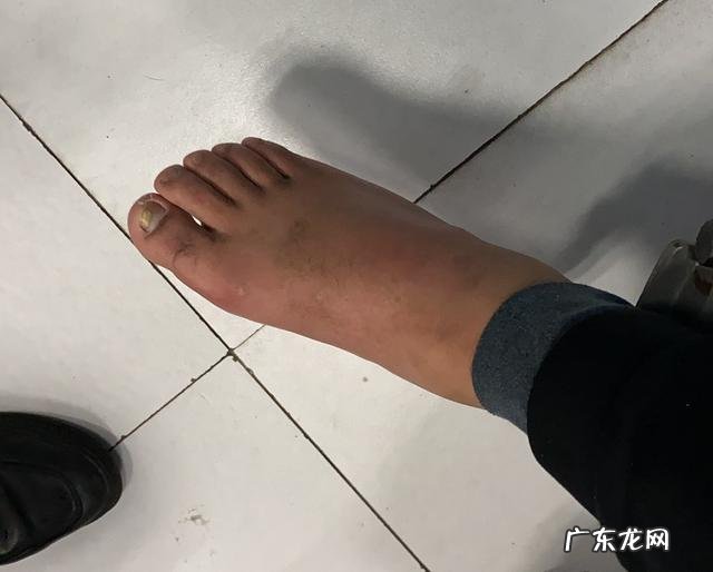 靠运动就能降尿酸吗,还有哪些方法可以快速降尿酸?