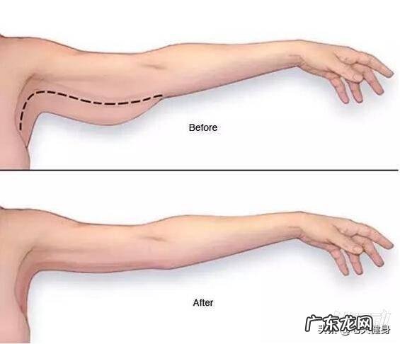 手臂上部拜拜肉突出,如下图,该怎样锻炼瘦手臂? 如何练出手臂力量且瘦手臂